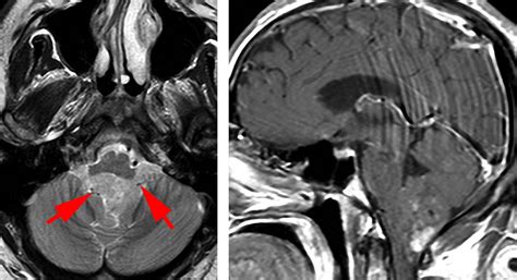 Fourth Ventricular Tumors The Neurosurgical Atlas By Aaron Cohen Gadol Md