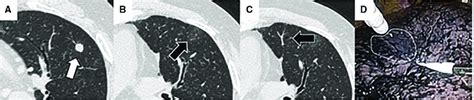 A Representative Case Of Virtual Assisted Lung Mapping VAL MAP With