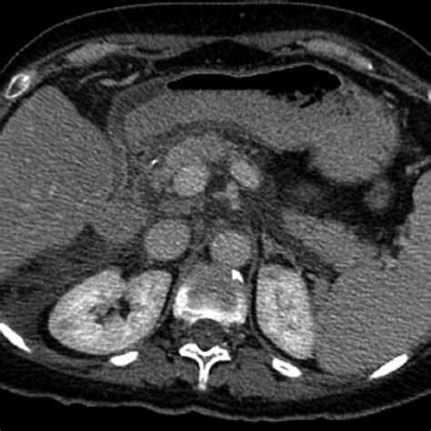 Computed Tomography Ct Scan Showing Distended Stomach With Severe Download Scientific