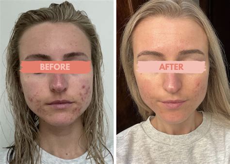 Acne Free Without The Pill Katie Stewart Wellness Reviews Katie