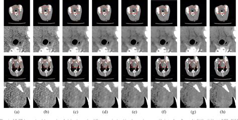 Figure From Low Dose Ct Image Denoising Using Multi Level Feature