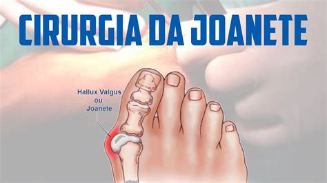 Como Funcionar A Cirurgia Da Joanete Tratamentos Tipos De Cirurgias