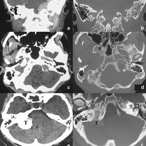 Juxtacondylar Approach For Jugular Foramen Meningioma Of Type Iv A