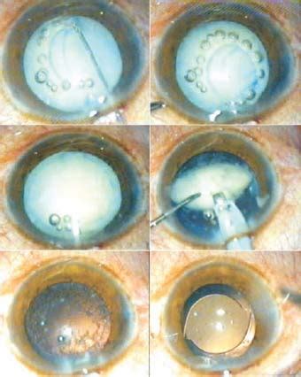 Capsulotomy in Difficult Cataracts | Ento Key