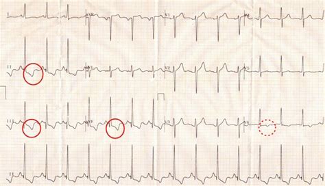 Ischémie myokardu EKG Medicína nemoci studium na 1 LF UK