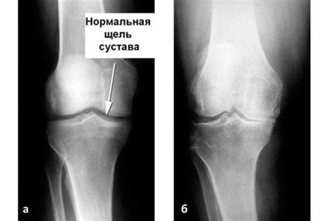 Боль в колене сбоку с внешней стороны особенности строения сустава и