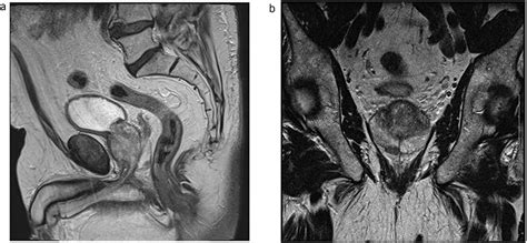 Prostatic Stromal Tumour Of Uncertain Malignant Potential Treated With