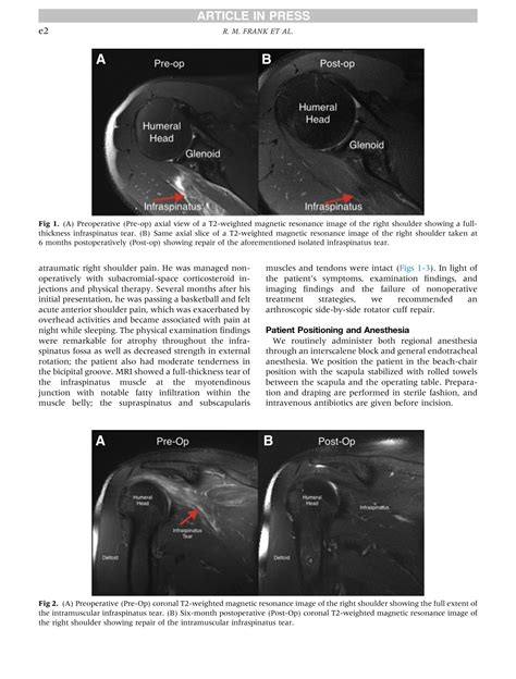 Solution Arthroscopic Intramuscular Side To Side Repair Of An Isolated