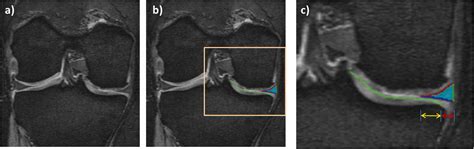 Association Of Quantitative Measures Of Medial Meniscal Extrusion With