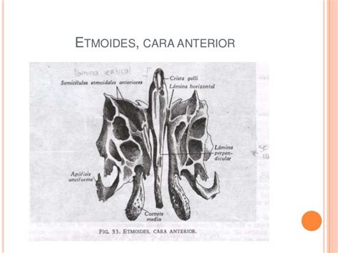 Etmoides