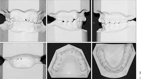 Figure 2 From Multidisciplinary Management Of A Fused Maxillary Central