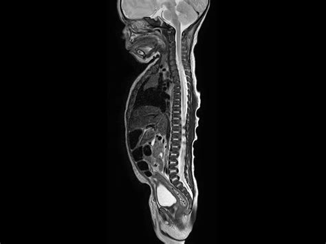 Pediatric Total Spine With Spina Bifida Philips Mr Body Map