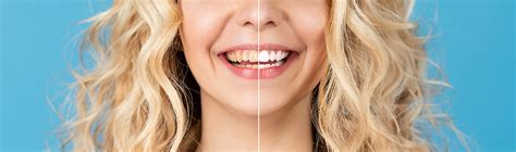 Teeth Whitening Vs Teeth Cleaning For Whiter And Brighter Smile