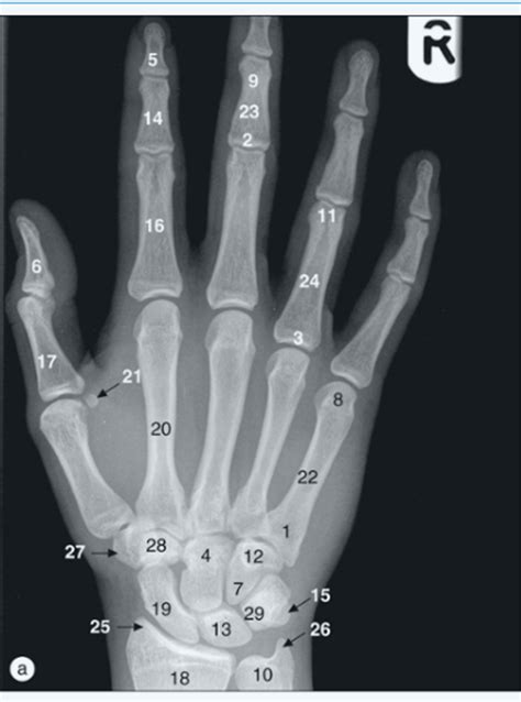 Hand X Ray Landmarks Diagram Quizlet