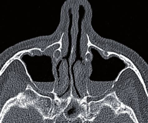 Axial Ct Demonstrates Bilateral Maxillary Sinus Fluid In Contrast To