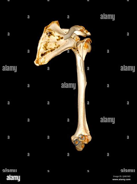 Computed Tomography Volume Rendering Examination Of The Shoulder Joint