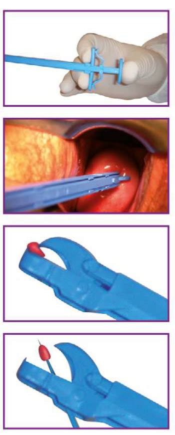 Cervical Biopsy Forceps Gyn And Push 25stk Med And Helse As