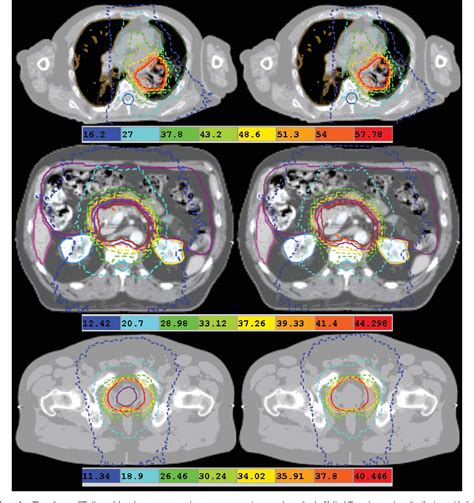 Figure 1 From Radiobiological And Dosimetric Analysis Of Daily Megavoltage Ct Registration On