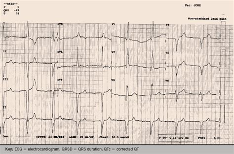 Abnormal Ekg Patterns