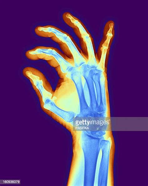 Degenerative Joint Disease Photos And Premium High Res Pictures Getty Images