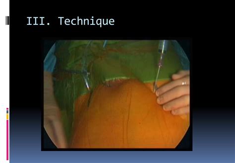 PPT La chirurgie cardiaque mini invasive assistée par vidéoscopie et