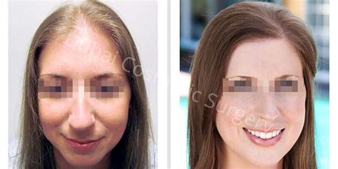 Female Hair Transplant In Dubai Dubai Cosmetic Surgery