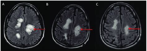 Comparison Of Brain Mri T2 Flair Axial Images Demonstrating Download Scientific Diagram