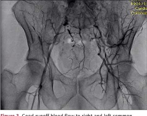 Figure 1 From Extra Anatomic Axillofemoral Bypass After Failed Stenting For Aortoiliac Occlusive