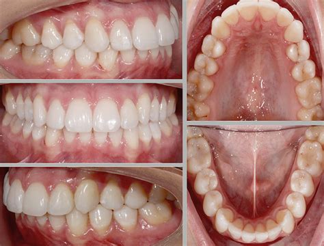 Invisalign Teeth Straightening With Clear Nearly Invisible Braces