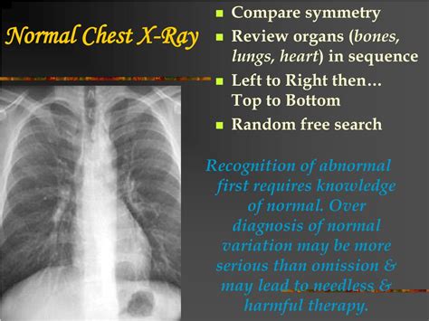 PPT - Chest X-Ray Review PowerPoint Presentation - ID:172434