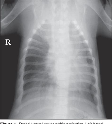 Figure 1 From Dynamic Right Ventricular Outflow Tract Infundibular