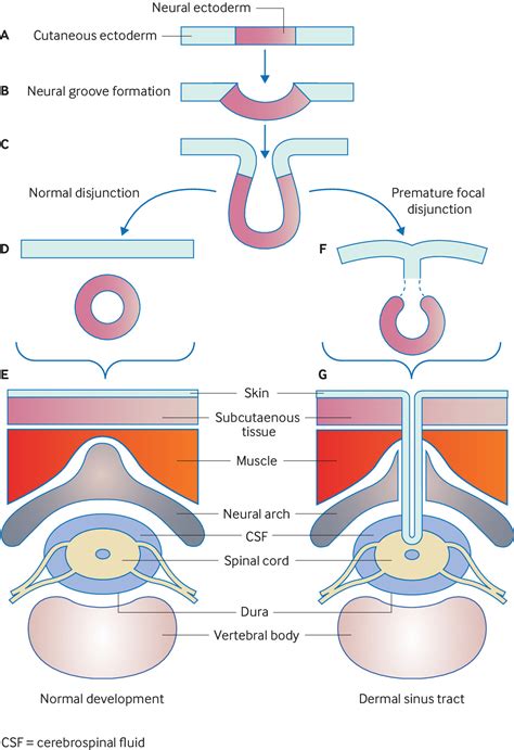 Dermal Sinus Tracts The Bmj