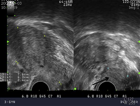 Transvaginal Ultrasonography Finding On The First Visit An Approximate Download Scientific