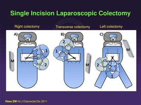 Ppt Single Incision Laparoscopic Colectomy Powerpoint Presentation