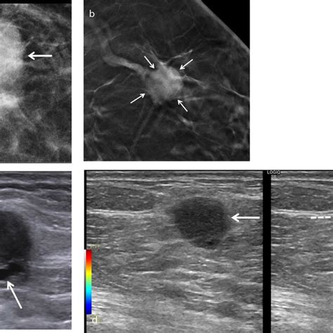 An Example Of Squamous Cell Metaplastic Breast Carcinoma In A Download Scientific Diagram