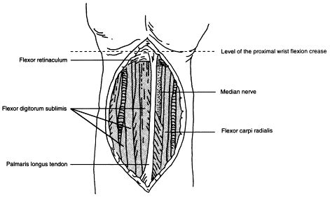 Autogenous Palmaris Longus Tendon As Frontalis Suspension Material For