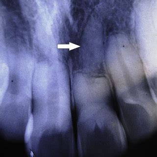 Radiograph Demonstrating Impacted Mesiodens Causing Resorption Of The