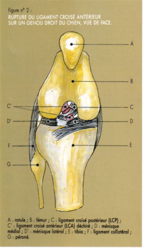 Les Fractures