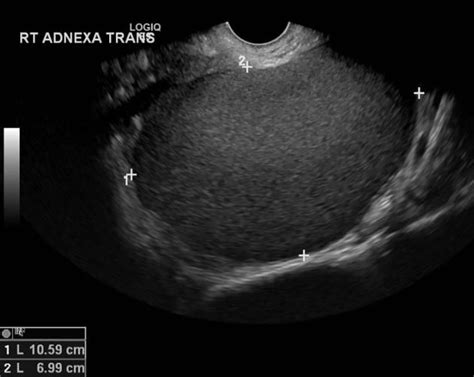 Endometrioma Radiology Reference Article Radiopaedia Org Medical