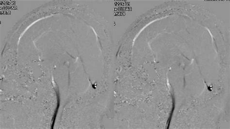 Figure 1 From Acquired Intraventricular Arachnoid Cyst Of The Third