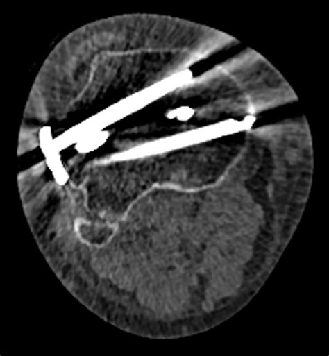 Dual Energy Ct For The Musculoskeletal System Radiology