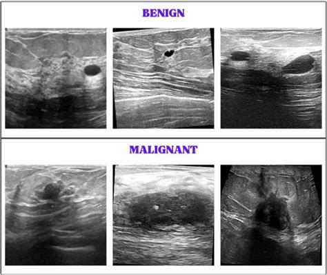 Figure From Advancing Breast Cancer Classification In Ultrasound