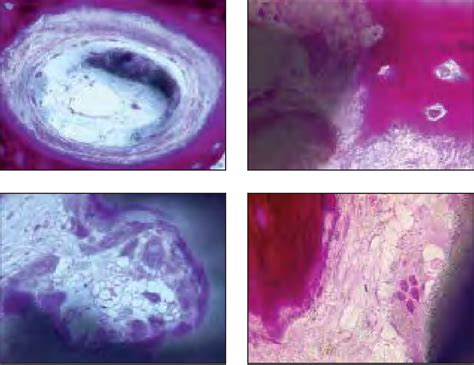 Figure 7 From Maxillary Sinus Grafting With Biphasic Calcium Phosphate