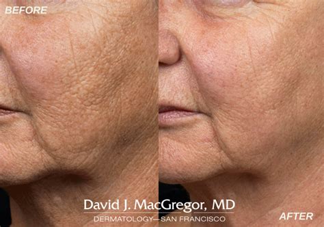 Fraxel DUAL Meet Skin Rejuvenation And Restoration 450 Derm