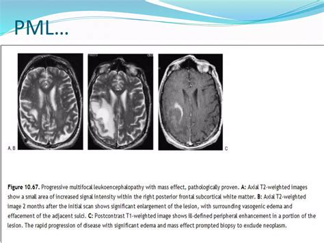 Radiology Of Demyelinating Diseases Ppt