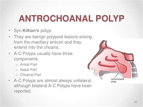 Nasal Polyposis