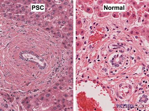 Primary Sclerosing Cholangitis Histology