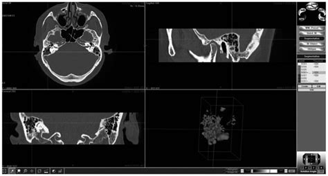 Three Dimensional Reconstruction Of Computed Tomography Scans Was Download Scientific Diagram