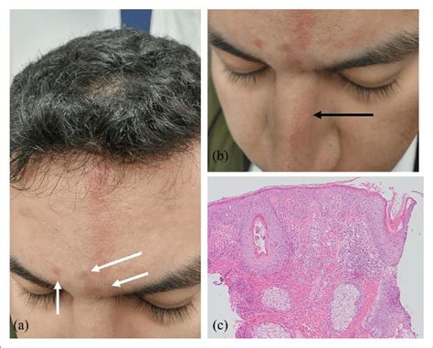 A Erythematous Plaque Runs From The Root Of The Frontal Scalp Down To Download Scientific