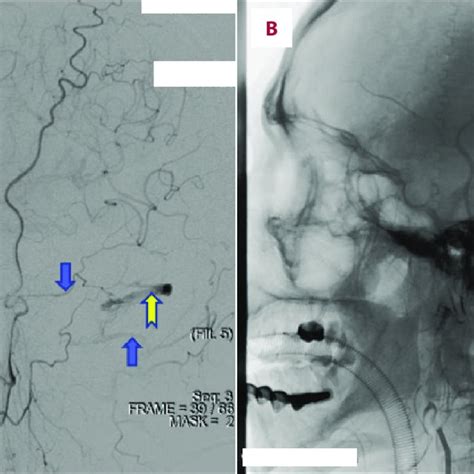 The Dsa Images In Case The Davf Was Supplied By Bilateral Vertebral